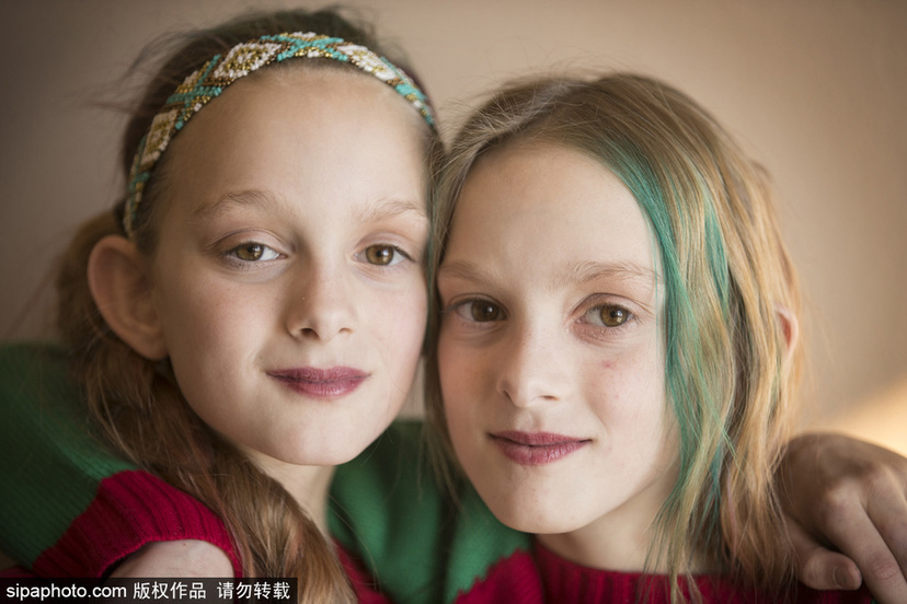 美国孪生连体姐妹分离手术后已茁壮成长11年