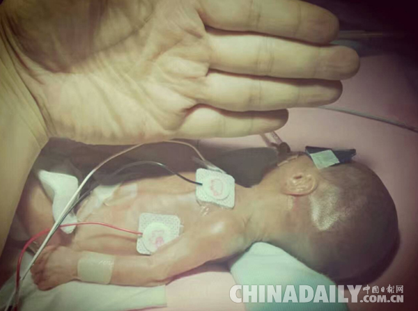 北京600克超早产儿只有成人手掌大小 已顺利出院