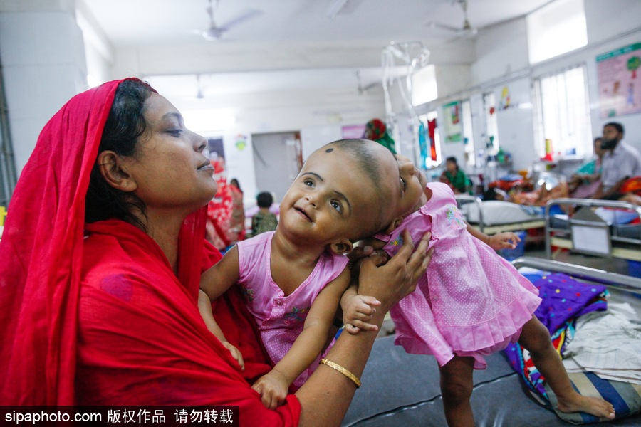 孟加拉国连头婴儿 至少到两岁才能进行手术