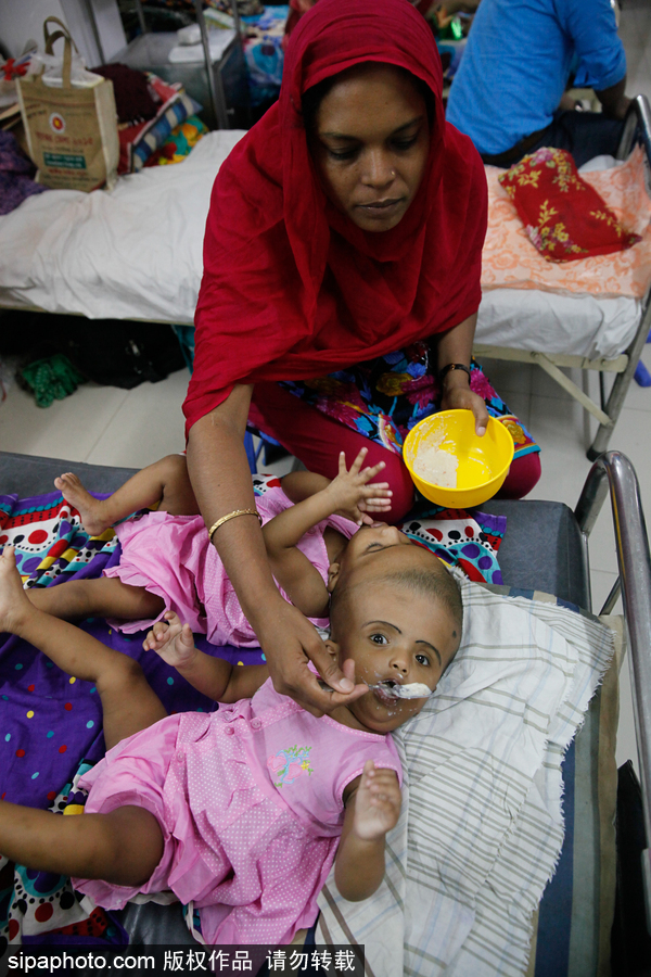 孟加拉国连头婴儿 至少到两岁才能进行手术