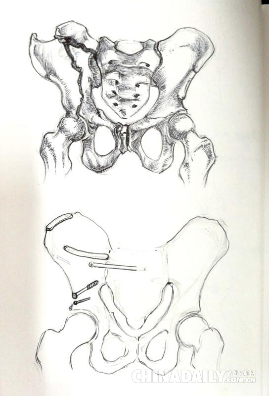 长沙一骨科医生六年手绘千幅手术图