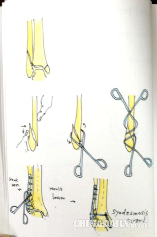 长沙一骨科医生六年手绘千幅手术图