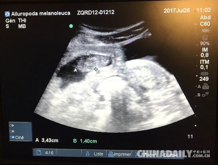 早孕双胞胎b超图片30天图片